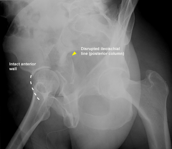 acetabular-fractures-trauma-orthobullets